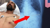 Workplace accident: Horror picture shows nail piercing man’s torso, almost hits heart - TomoNews