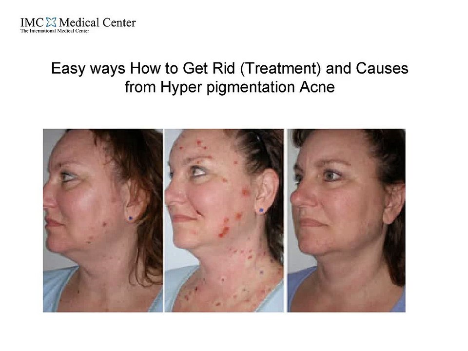 Easy_ways_How_to_Get_Rid_Treatment