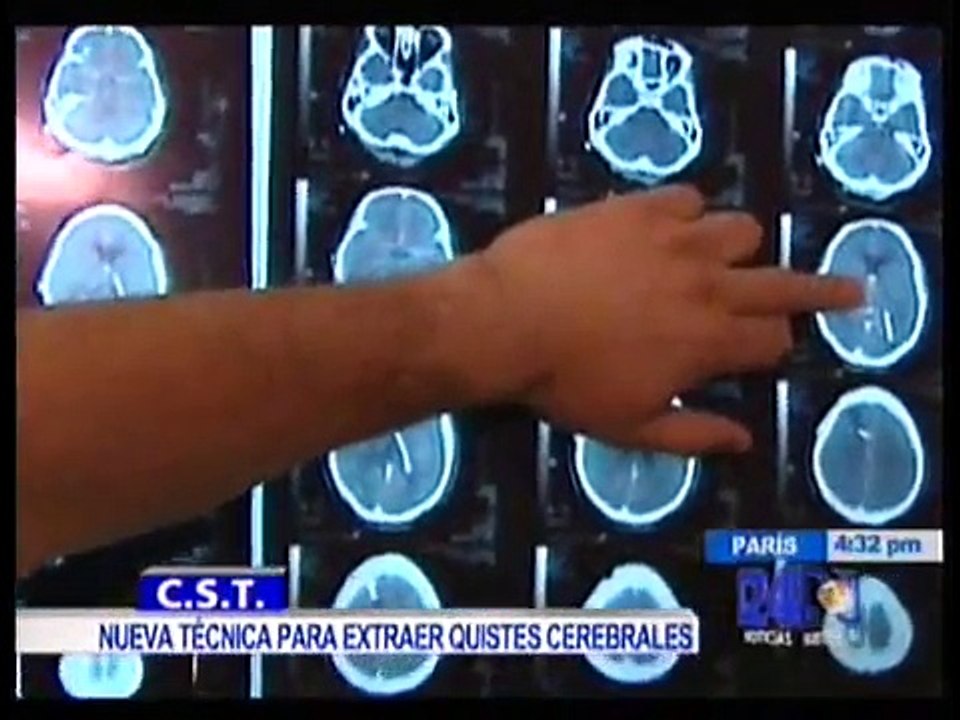 Quiste aracnoideo temporal tratamiento neuroendoscopico