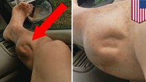 Otot seorang Pria bergerak sendiri karena mengalami Kram otot ekstrim - TomoNews