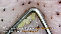 Cận cảnh màn gắp mụn đầu đen khiến người xem lợm giọng