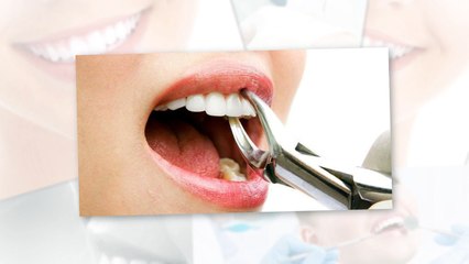 Wisdom Teeth Removal in Gulfport, MS