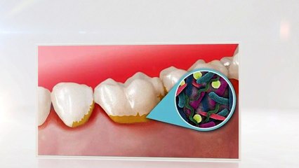 Gum Disease Laser Therapy in Plantation, FL