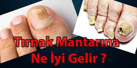 Tırnak Mantarına Ne İyi Gelir