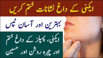 3 Best Tips to Remove Acne Scars at Home