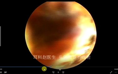 12 part Earwax Removal, Extractions 12段耵聍清理的大合辑，外耳道挖耳屎清理 耳垢 耳垢