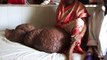 40-year-old Bangladeshi woman has a leg that weighs 60 kg
