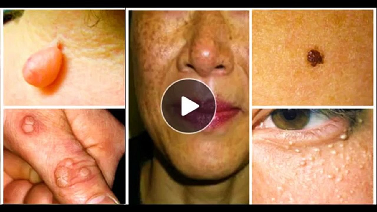 Âge et comédons complètement détruire naturellement Peau taches mots clés verrues votre moles