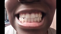 [WARNING] Teeth Whitening Baking Soda and Lemon - Bad Reion - Before & After | The Mout