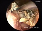 Earwax Removal, Extractions Cleaning after Otitis media Surgery 中耳炎手术的清理 外耳道挖耳屎清理 耳垢 耳垢