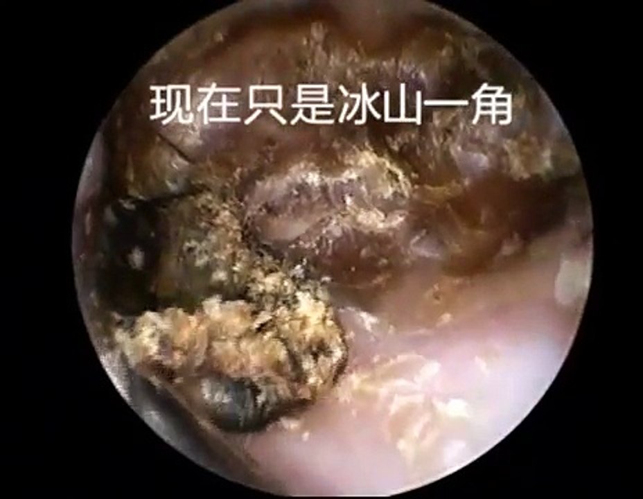 Earwax Removal, Extractions Much bigger than expected 本来以为是一小块耳屎，取出来吓一跳 外耳道挖耳屎清理 耳垢 耳垢