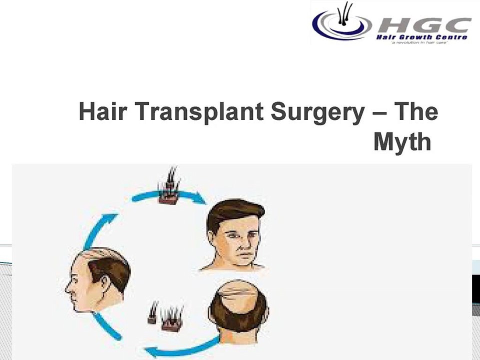 Hair_Transplant_Surgery_The_Myth