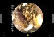 Earwax Removal, Extractions Black Huge and Hard EXTRACT by hook 黑色坚硬耳屎大合集 外耳道挖耳屎清理 耳垢 耳垢