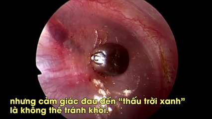 Bọ ve kí sinh trong tai người, gắp ra vẫn cố “ăn thịt” vật chủ