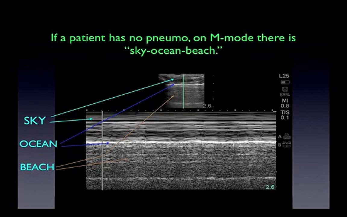 Ultrasound video 13-Critical-Care-Ultrasound-Vignettes-3
