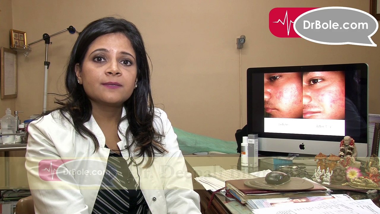 Primary treatment and other treatments for Acne_Dr. Deepali Bhardwaj_Skin & Hair Specialist_Skin & Hair Clinic, New Delhi_DrBole.com