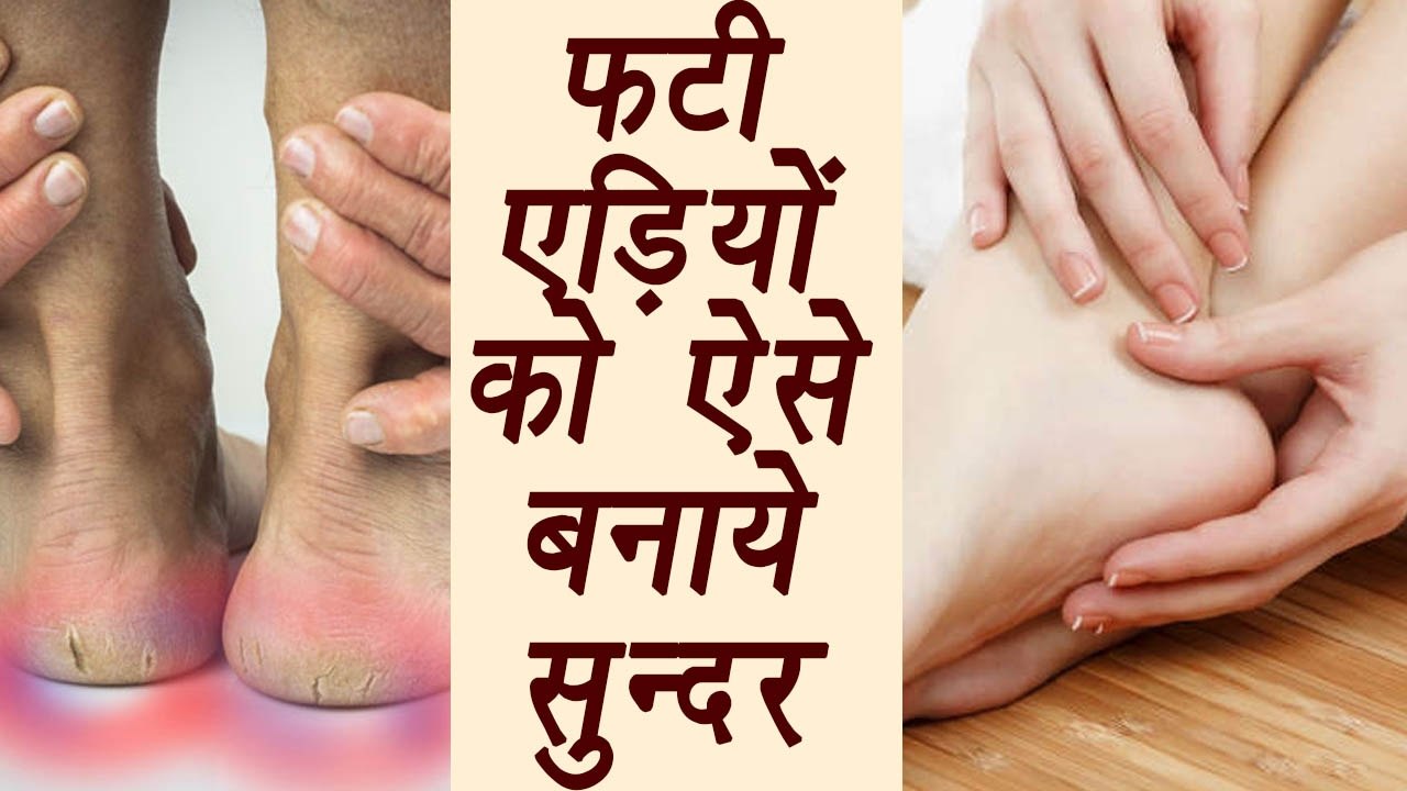 Cracked heels treatment with Home remedies | फटी एड़ियों को ऐसे बनाये सुन्दर | Boldsky
