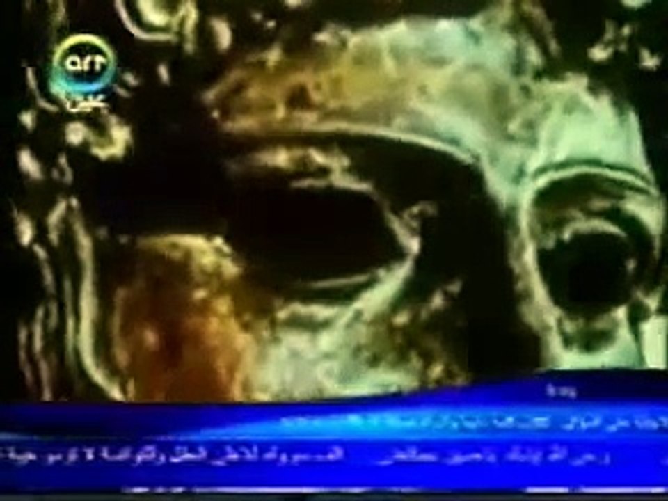 مرض الملوك