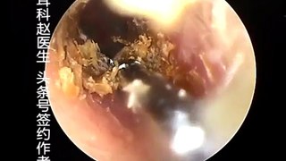 Earwax Removal, Extractions From a Kid Part 2 Tweeze Out Earwax 小朋友来复诊 外耳道挖耳屎清理 耳垢 耳垢