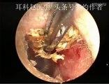 Earwax Removal, Extractions UNEXPECTED SIZE! Part 2 清理耳内结痂 外耳道挖耳屎清理 耳垢 耳垢