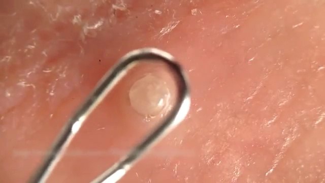 Những pha nặn mụn nhìn thôi là thấy đã