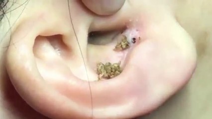 Pha nặn mụn lâu năm