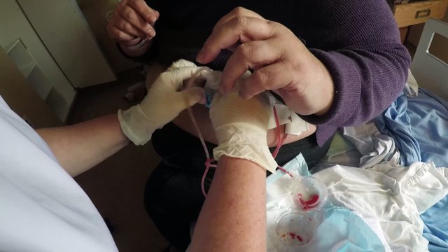 Learning how to empty the Surgical Drains after a Mastectomy