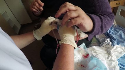 Learning how to empty the Surgical Drains after a Mastectomy