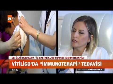 Vitiligo'da yeni tedavi yöntemi - atv Gün Ortası Bülteni