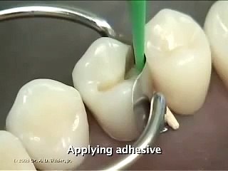 Composite Class II Preparation and Restoration on Premolar