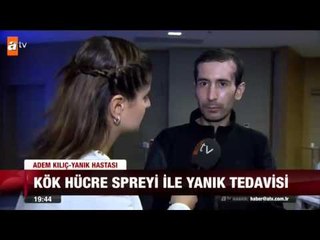 Kök hücre spreyi ile yanık tedavisi - atv Ana Haber