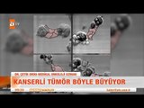 Kanserli tümör böyle büyüyor - atv Kahvaltı Haberleri