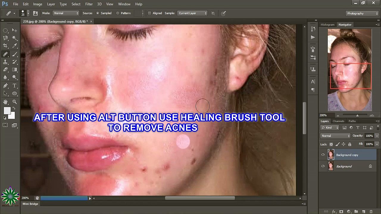 Use of HEALING to remove acnes | NICE ONE TUTE | NICE ONE CREATION | MUST WATCH |