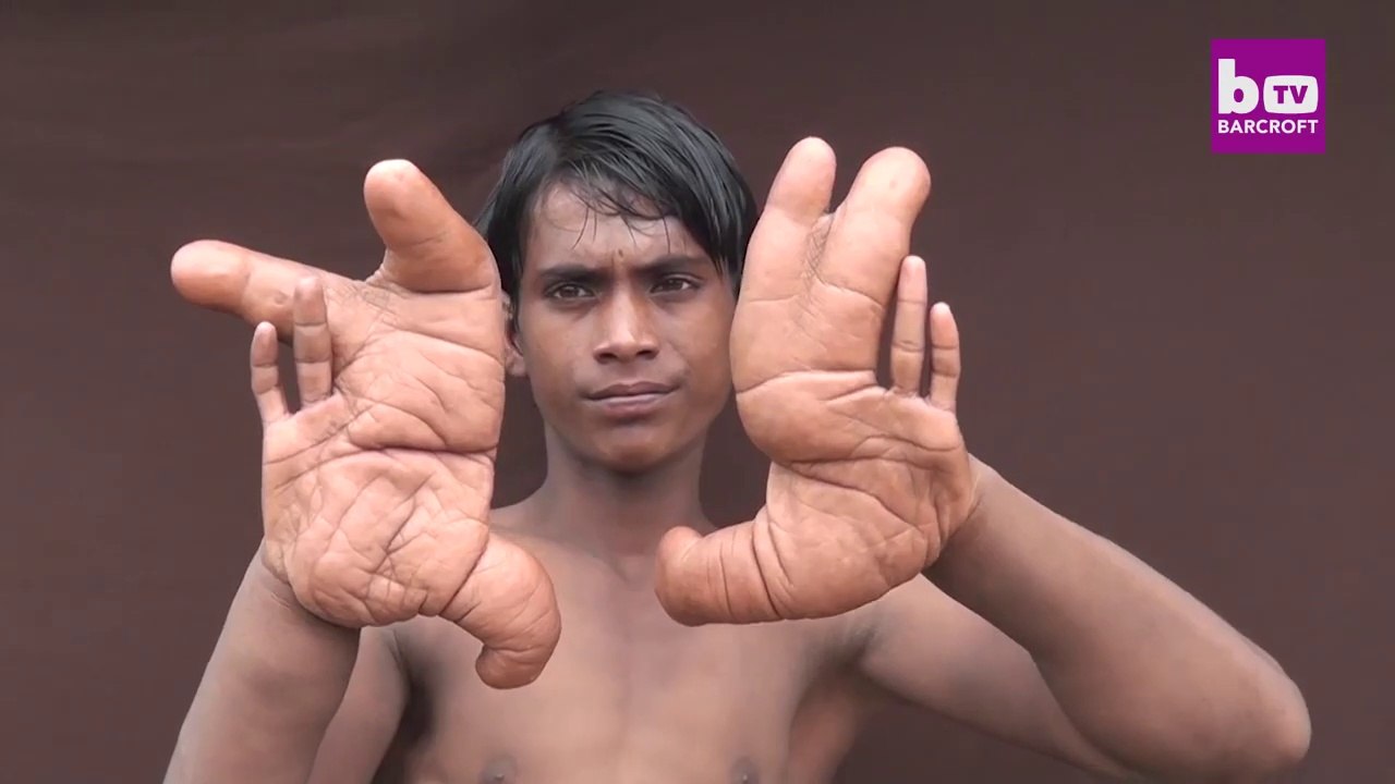 Cet ado est né avec des mains géantes