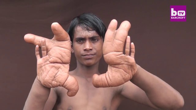 Cet ado est né avec des mains géantes