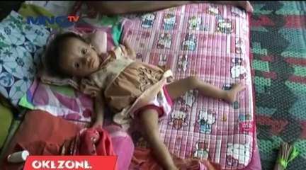 Ironis! Bocah 1 Tahun Ini Hanya Punya Berat Badan 3 Kilogram