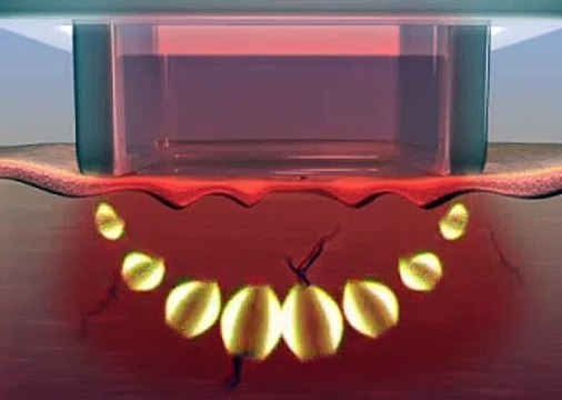 Best Treatment For Wrinkles and Skin Tightening