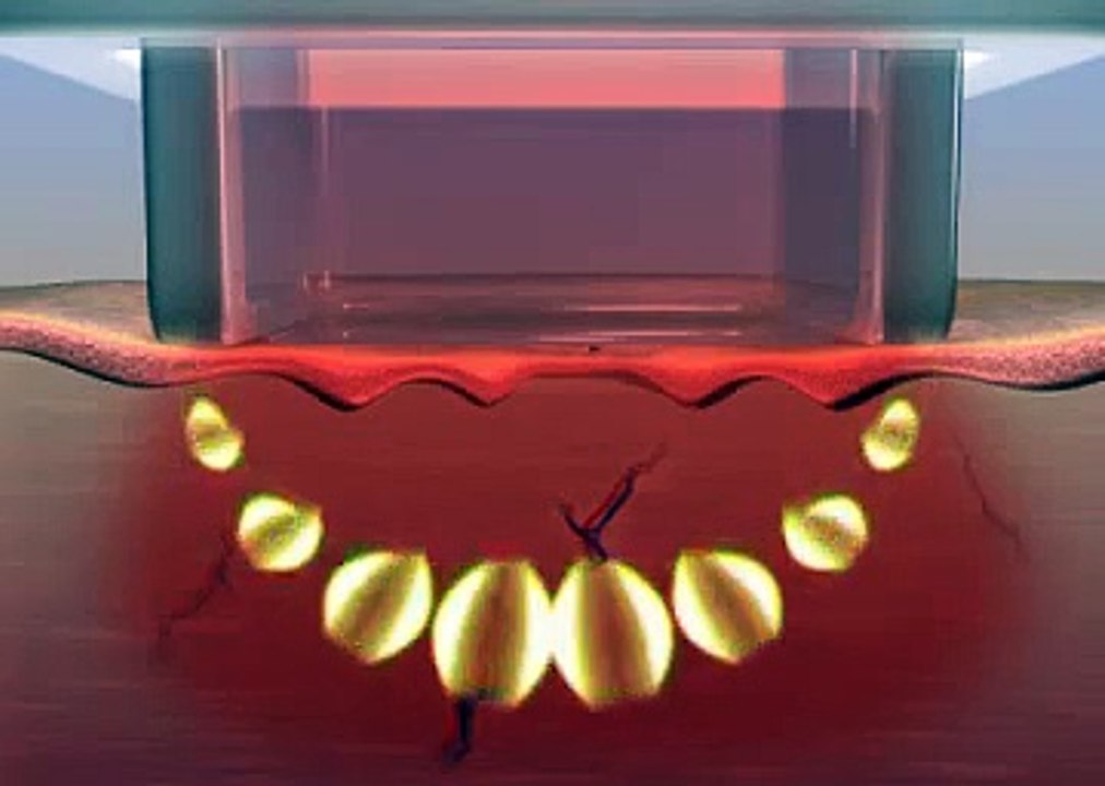 Best Treatment For Wrinkles and Skin Tightening