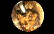 12 part Earwax Removal, Extractions 12段耵聍清理的大合辑，外耳道挖耳屎清理 耳垢 耳垢