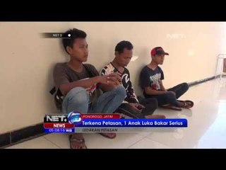 Terkena Petasan, Anak Ini Alami Luka Bakar Serius - NET5