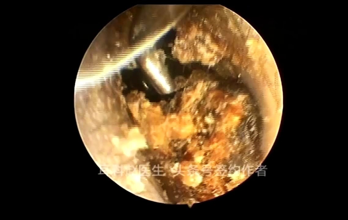 12 part Earwax Removal, Extractions 12段耵聍清理的大合辑，外耳道挖耳屎清理 耳垢 耳垢