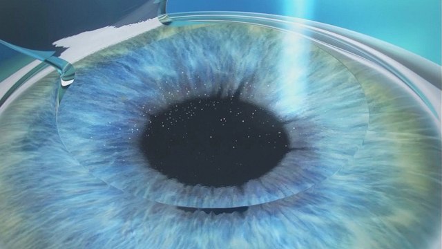 Las ventajas del rayo láser en cirugía refractiva