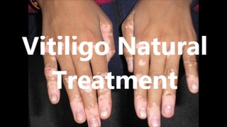 How to Cure Vitiligo Fast Naturally at Home