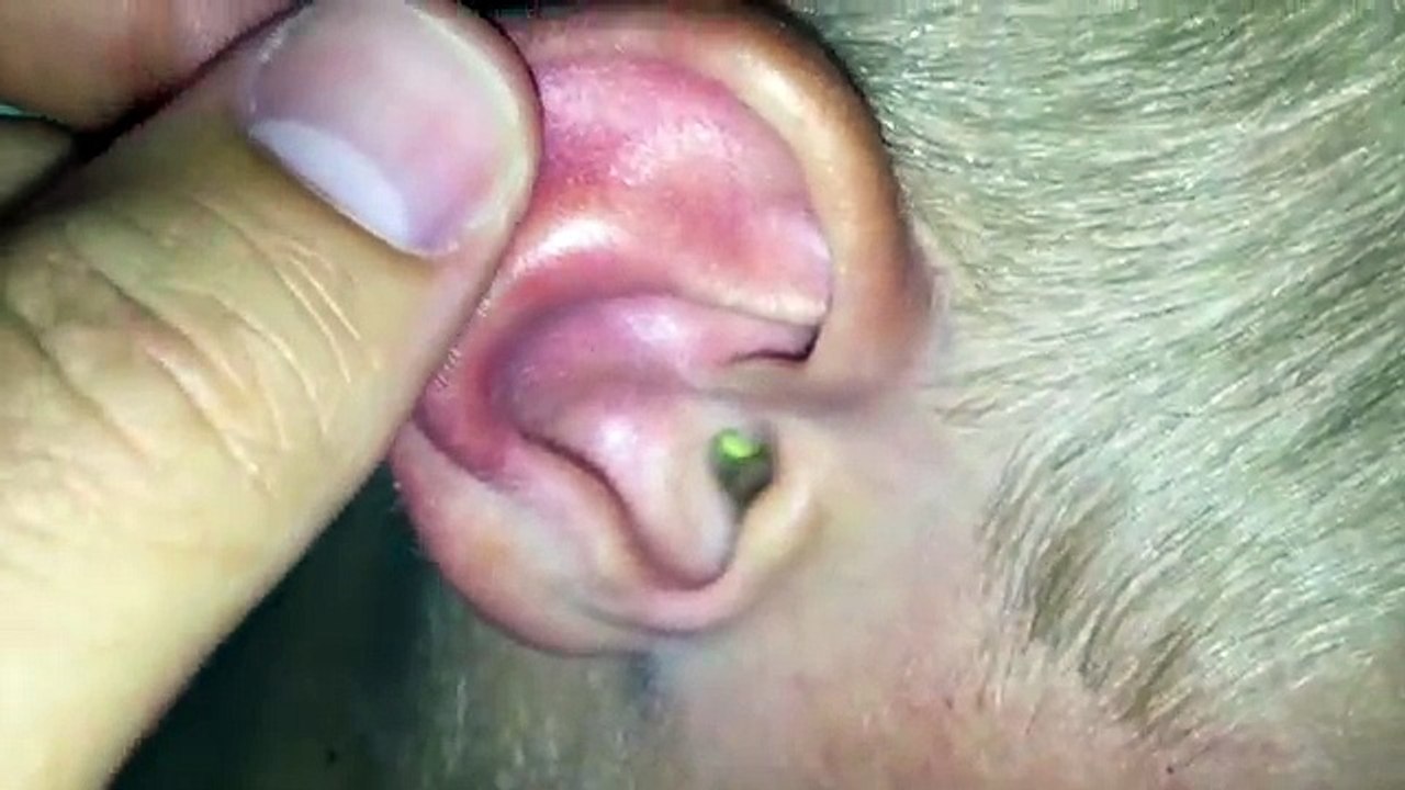 Help Me! Theres Something Stuck In My Ear! - Bizarre ER - BBC Three