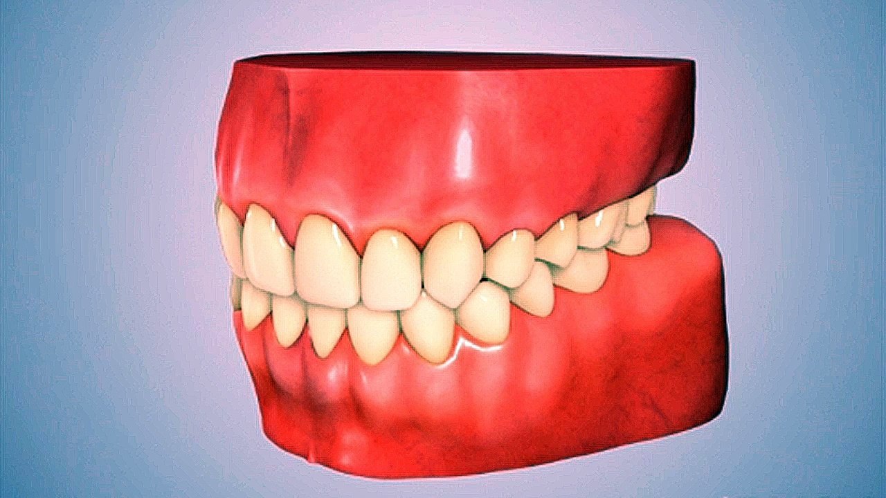 Bridge Bone Loss
