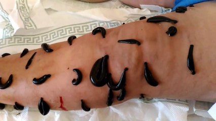 Terapia me shushunja është përdorur për shekuj të tërë për të trajtuar një gamë të gjerë të sëmundjeve