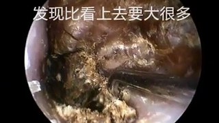 Earwax Removal, Extractions Much bigger than expected 本来以为是一小块耳屎，取出来吓一跳 外耳道挖耳屎清理 耳垢 耳垢