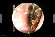 Earwax Removal, Extractions Black Huge Earwax Take out after Soften 大黑硬菜软化后取出 外耳道挖耳屎清理 耳垢