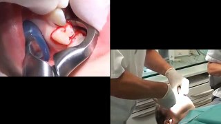 Inférieur molaires de de procédure Extrion caduc
