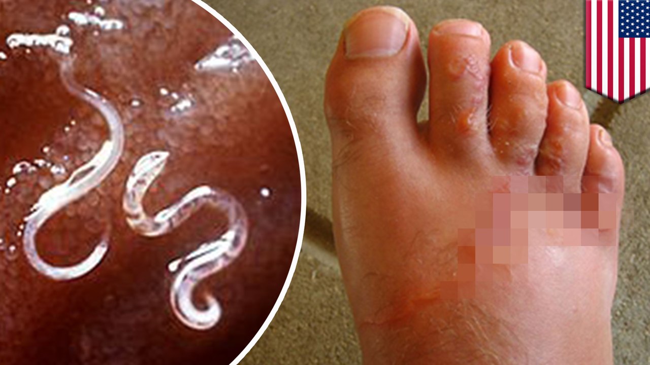 Third world parasite plaguing rural Alabama county
